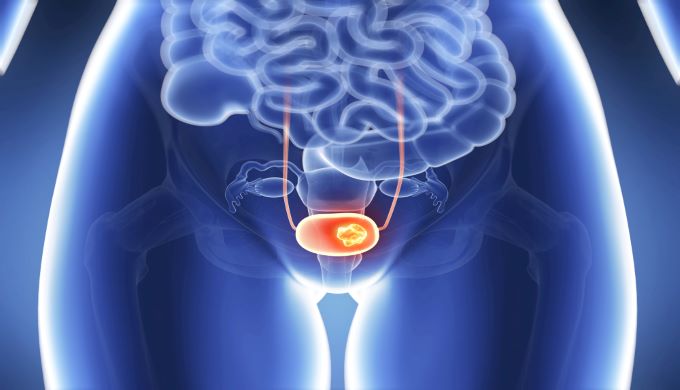 Illustration of bladder cancer