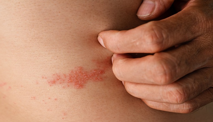 Man with shingles disease, skin infected with Herpes zoster