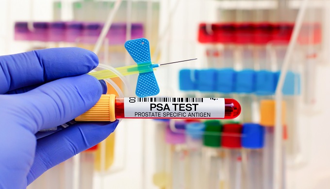 doctor with Blood tube and catheter for PSA Prostate specific antigen test in biochemistry lab