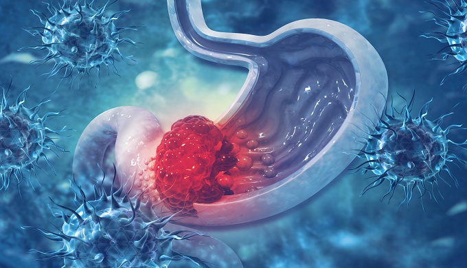 Stomach cancer. Cancer attacking cell. Stomach disease concept. 3d illustration