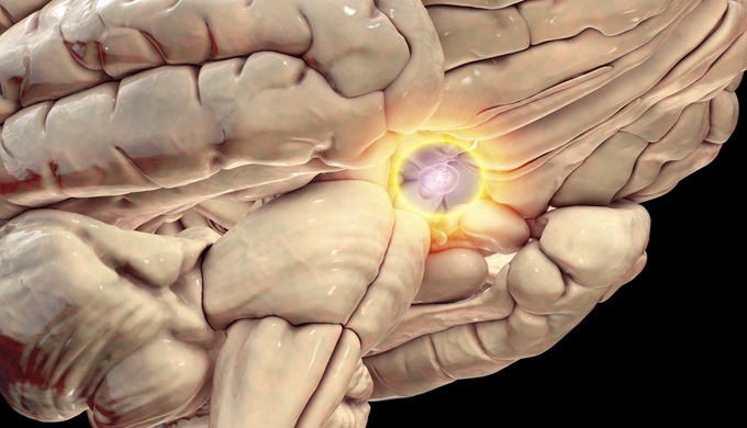 Pituitary gland tumour. Computer illustration highlighting its location and impact on nearby structures.
